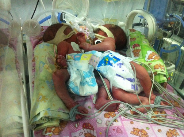 Bayi perempuan kembar siam dempet pada perut lahir prematur di RSUD Sidoarjo. Bayi kembar siam ini akan dirujuk ke RSU Dr Soetomo